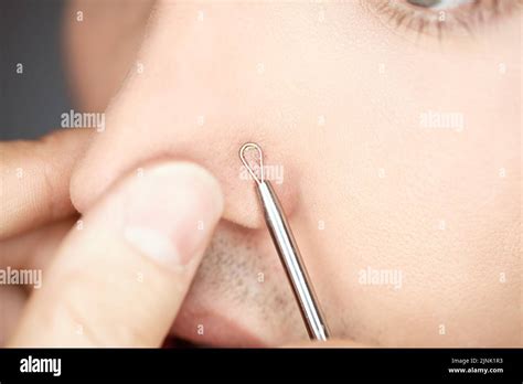 how to clean out blackheads