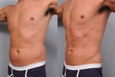Liposuction Before And After Men