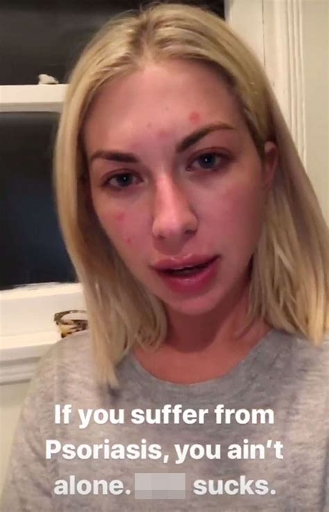 Stassi Schroeder Gets Real About Her Psoriasis in Makeup-Free Selfie