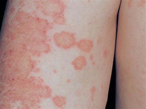 nummular eczema pictures symptoms treatment