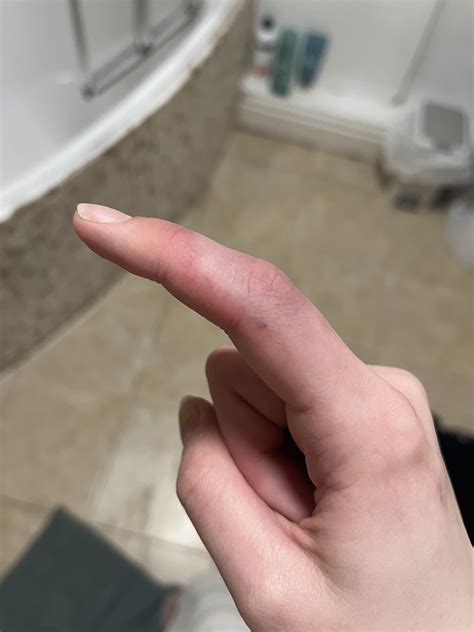 mysterious finger swelling and pain : r/medical