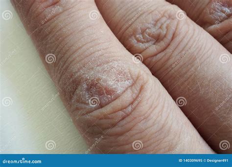 Cracked Skin Royalty-Free Stock Image | CartoonDealer.com #18902914