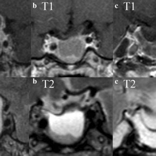 Treatment effect of cabergoline on giant prolactinoma. Coronal T2 MRI ...