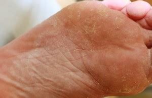 👉 Tinea Pedis - Treatment, Pictures, Symptoms and Causes (December 2021)