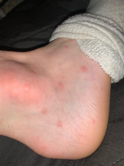 Itchy bumps on both my ankle, thought they were bug bites until it