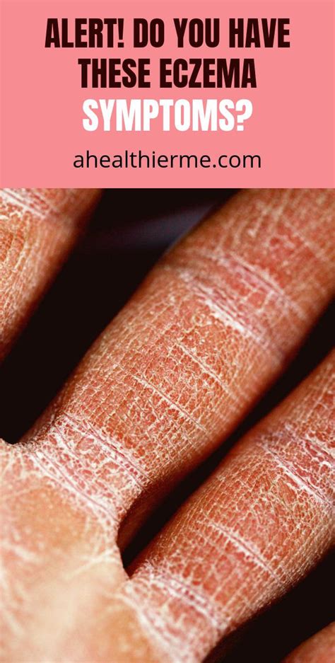 Alert! Do You Have These Eczema Symptoms? - A Healthier Me