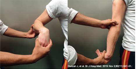 Epicondilite lateral do cotovelo ("tennis elbow") | Dr Fernando Brandão