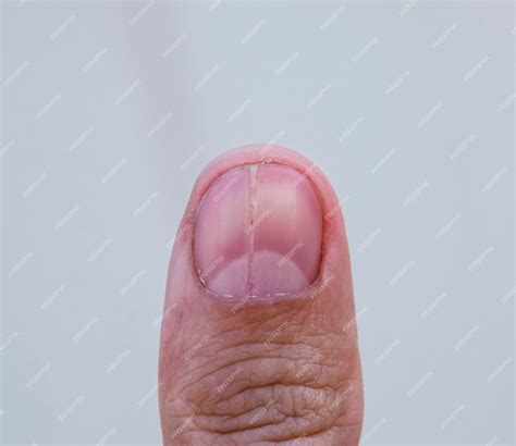Premium Photo | Forked nail on the thumb dilation of the nail traumatic