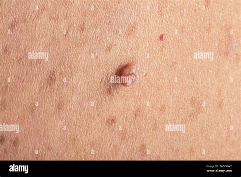 neurofibromatosis neurofibroma growth   skin    year