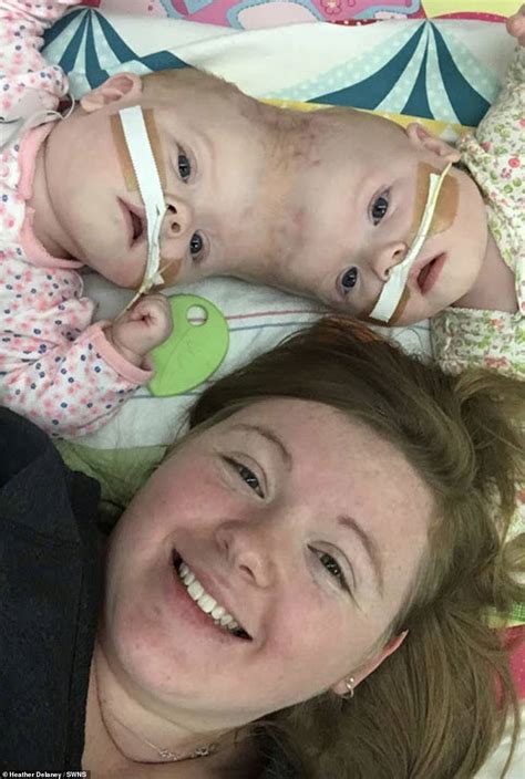 Siamese twins joined at the head defy odds and graduate kindergarten ...