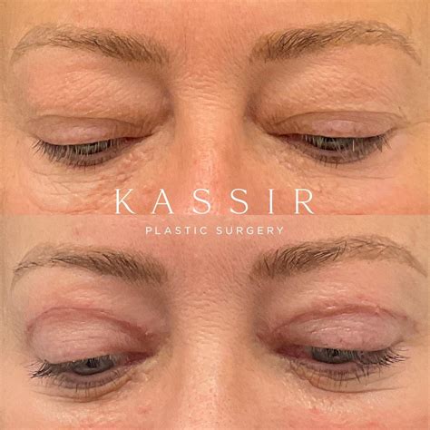One month after blepharoplasty / eyelid surgery — Kassir Plastic ...