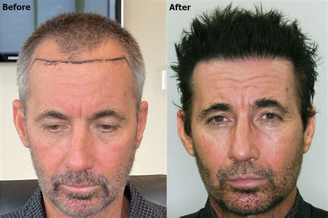 hair transplant    hairline