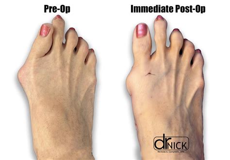 Minimally invasive bunion surgery : r/bunions