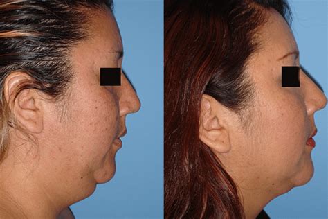 Neck Liposuction Results Orange County | Dr. Michael Jazayeri