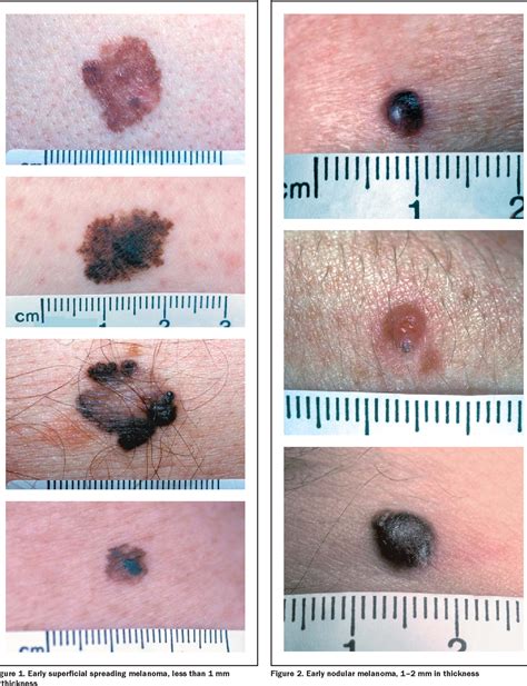 nodular melanoma usa stockists wwwpinnaxiscom