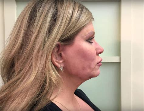 Woman Bullied for Her 'Pelican Neck' Had 2 Botched Facelifts