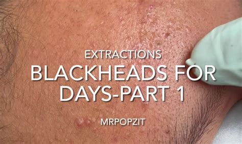 Blackheads for days part 1. 12 minutes of just the pop.acne extractions ...