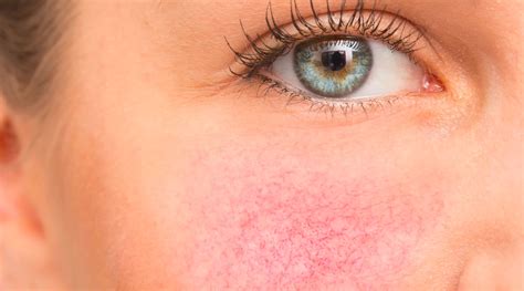Why Are My Cheeks Always Red? – Grahams Natural USA