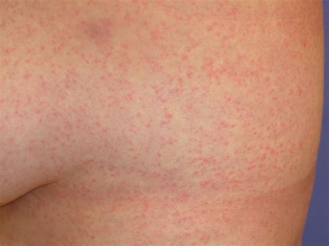 viral rash  types  symptoms  treatment