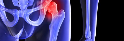 Outpatient Total Joint Replacement Surgery - Charlotte Surgery Center ...