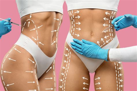 Como Funciona A Lipo Sem Corte - Lipoaspiracao Antes E Depois Da Barriga Lipo Sem Corte: Entenda Como