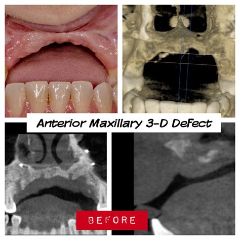 Reconstruction of a Severe Upper Jaw Defect For Dental Implants