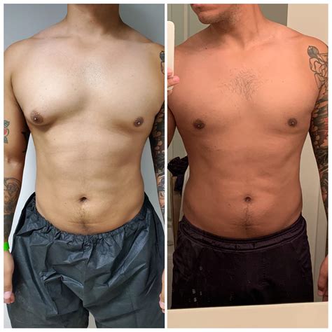 3 Weeks Post Op : r/gynecomastia