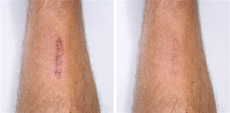 Triancil Queloide Antes E Depois - Cicatrices inestéticas y queloides - Ghorchi Clinic