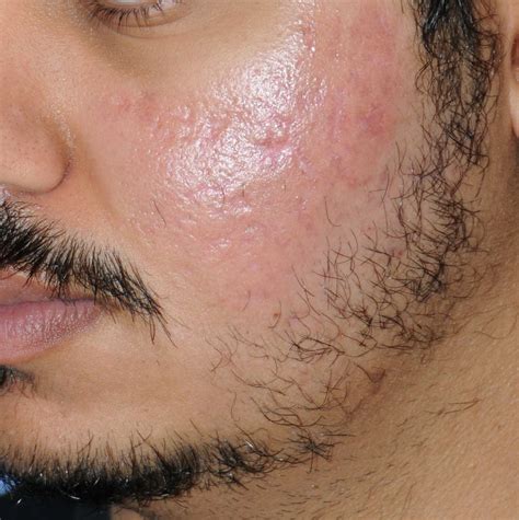 Best Tactic to Prevent and Treat Beard Acne | Beard & Acne