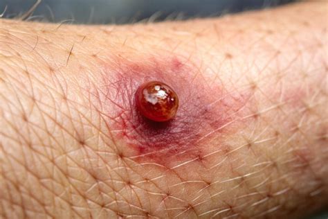 Bola De Sangue Na Barriga - Close-up de bolhas de sangue Anomalias cutâneas intrigantes Imagem ...