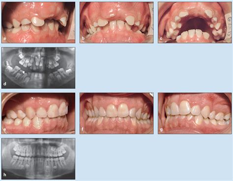 Orthodontic Management of Hypodontia | Pocket Dentistry