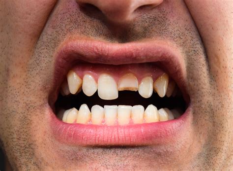 chipped tooth     family emergency dentist redwood