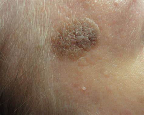 Seborrheic Warts Removal Richmond - vrogue.co