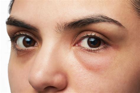 facial swelling    treatments   puffy face