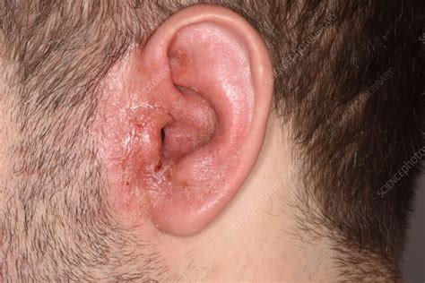 otitis externa pictures