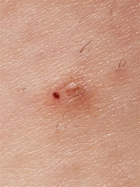 Can you scrape melanoma off like a scab? : r/Melanoma