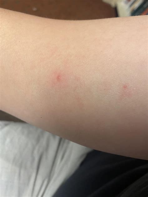 Hiv Pictures Of Rashes