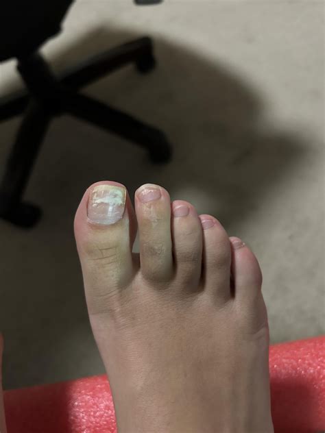 Why do my toenails look like this? Do feel slight numbness on (left