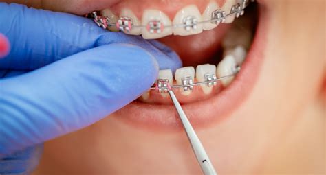 Power Chain Braces – Everything You Need To Know – Dr Braces