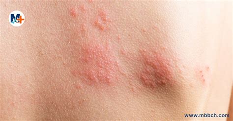 Cholinergic Urticaria - MBBCH Health Encyclopedia