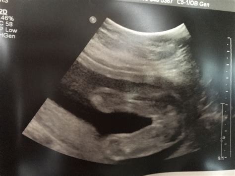 20 Weeks Ultrasound Girl