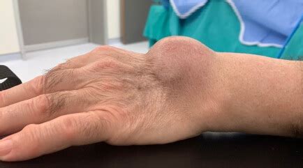 movable lump  skin  wrist infoupdateorg