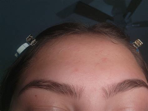 [Acne] How do i get rid of these red blotches/acne on my face? : r