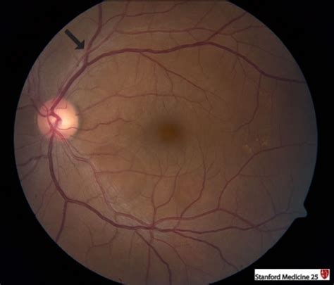 Fundoscopic Exam Abnormal Findings