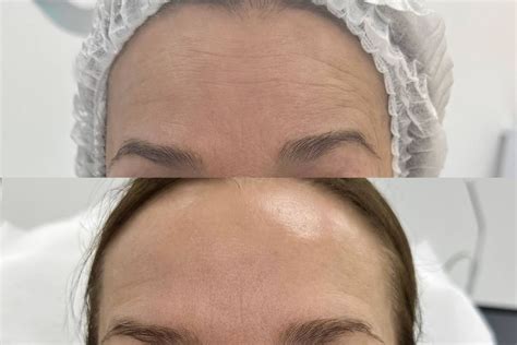 Ботулинотерапия лица в косметологии VIP Clinic в Москве. Цены на ...