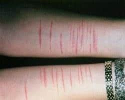 harm cuts  arm