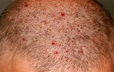 Scalp Folliculitis Causes Symptoms And Treatment - vrogue.co