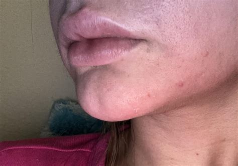 Cleft Chin Before And After