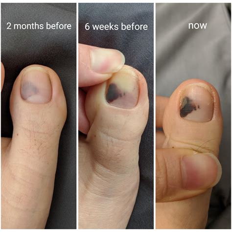 Big Toenail Has Vertical Light Brown Line Melanoma