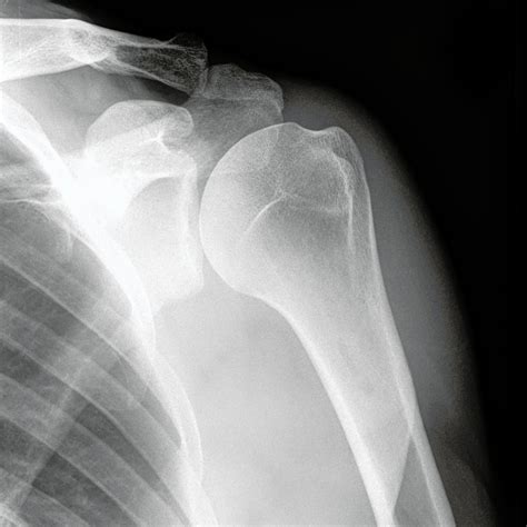 Shoulder X Rays Of Normal Shoulder